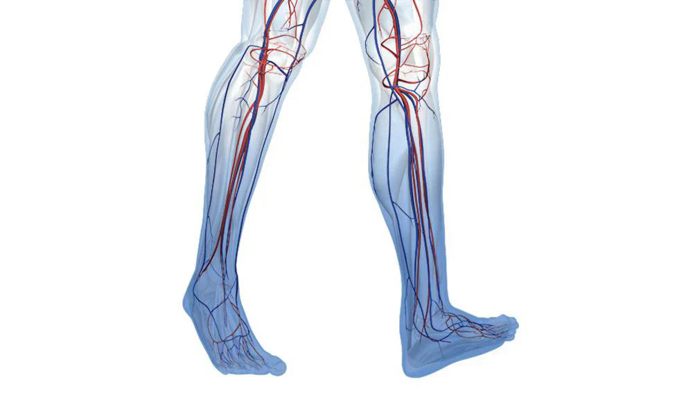 Chronic Venous Insufficiency (CVI) - Causes, Diagnosis and Treatment