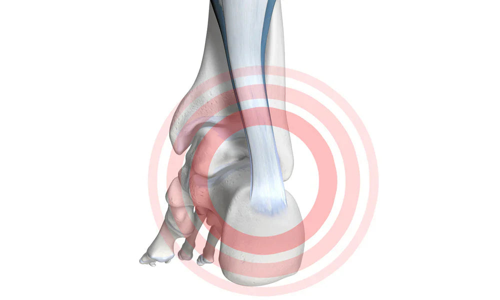 Haglund’s Deformity