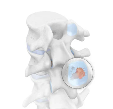 Spondyloarthritis - Arthritis of the Spine